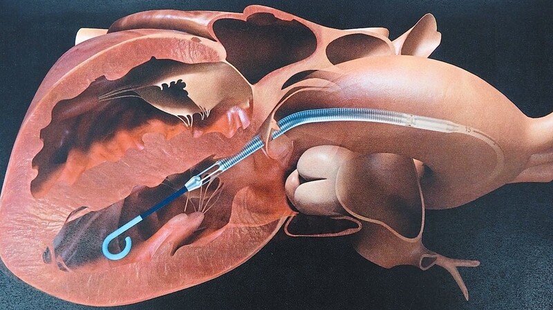 Die Pumpe wird ins Herz eingeführt.